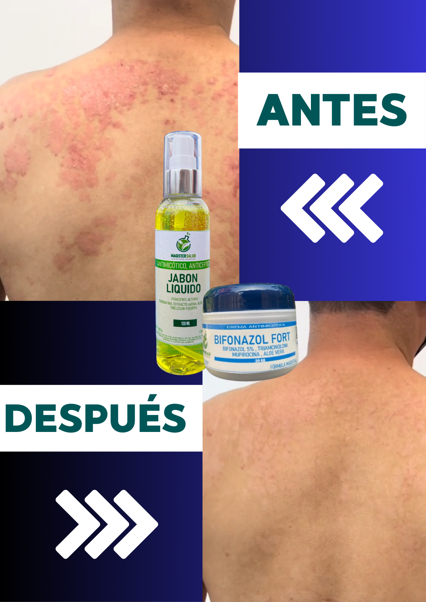 PACK ELIMINA HONGOS 100% ( Bifonazol Fort +  jabón líquido antimicótico )