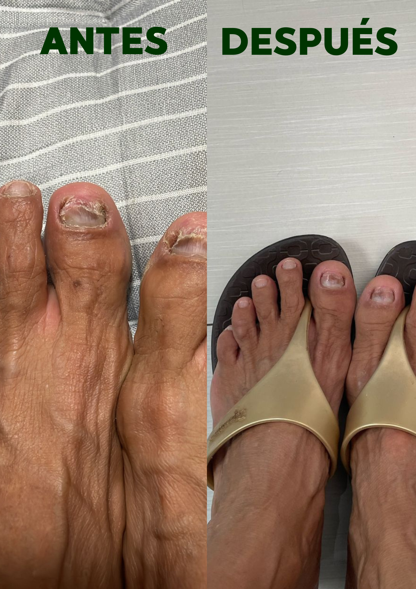 TERBINAFINA DOBLE ACCIÓN (Elimina los hongos de las uñas de tus pies) jabón Antimicótico + Terbinafina