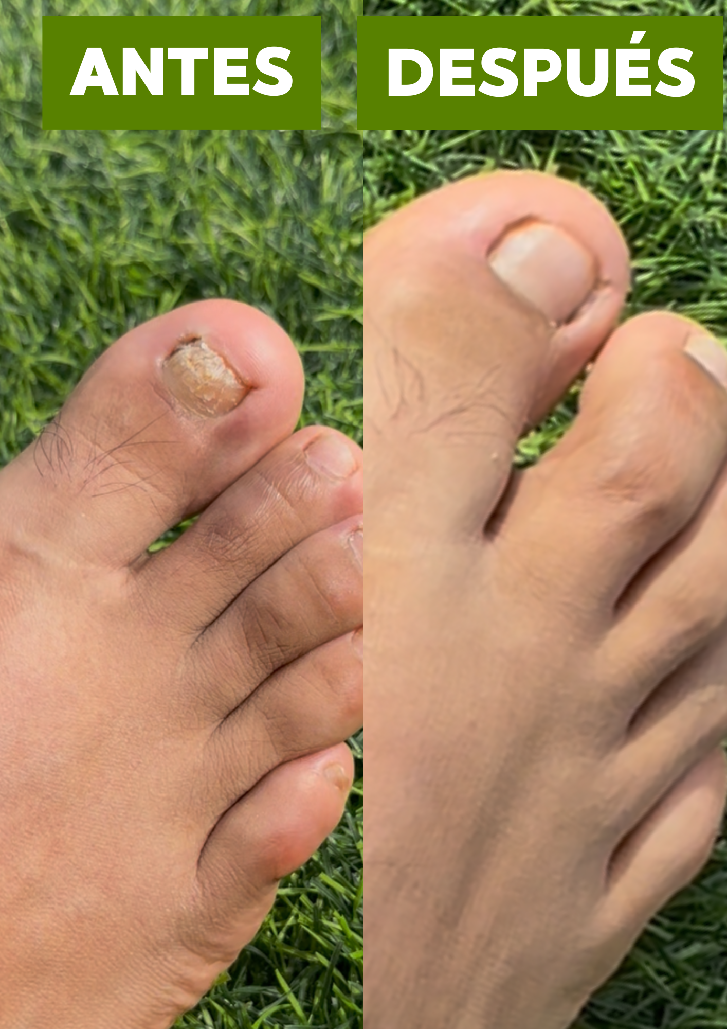 JABON ANTIMICÓTICO TERBINAFINA (ELIMINA EL HONGO DE RAIZ)