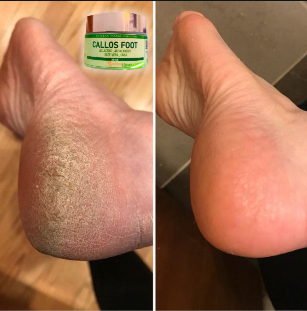 CALLOS FOOT (ESTÉTICA MAGISTRAL EN TUS PIES)